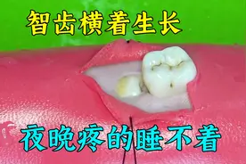 智齿横着长，疼得要命，拔掉后整个人都舒服了！