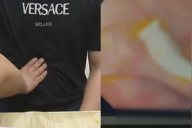 男子连续数月腹痛腹泻，检查发现肚里生虫？医生：与烹饪方式有关