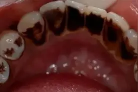 烟渍又黄又臭怎么办？掌握三个小技巧，在家就能轻松去渍白牙！