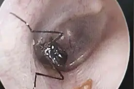 女子耳朵里传来“窸窣”声，医生从里面取出一只活蜘蛛