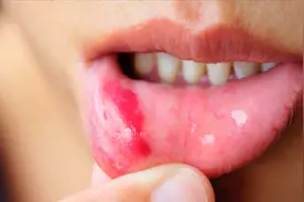 唾液带血是癌症吗？不一定！口腔出血原因主要有以下四点视频封面