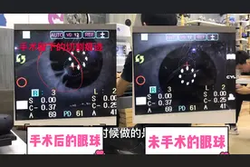 近视手术前对比未做近视手术哪个眼睛更完整？配镜老师傅带你揭秘