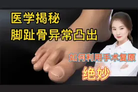 医学揭秘 脚趾头一根脚趾骨异常突出 如何利用手术修复 看完你懂