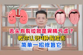 舌头有裂纹就是肾精亏虚？教你认识4种裂纹舌，简单一招修复它视频封面
