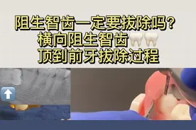 阻生智齿一定要拔除吗？深圳横向阻生智齿顶到前面牙齿拔除过程