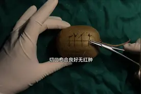 手把手教你手术后如何拆线，学会以后就不用去医院了。