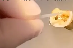 科普一下什么情况下需要打桩做冠！并给大家解释一下什么是打桩？