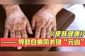 导致白癜风的“元凶”找到了！2分钟告诉你，白癜风的几大诱因！