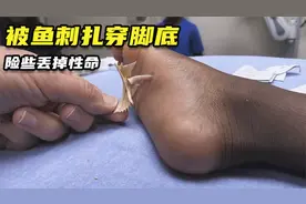 小男孩被鱼刺贯穿脚底，医生手法很是独特，妈妈的脸都被吓黑了