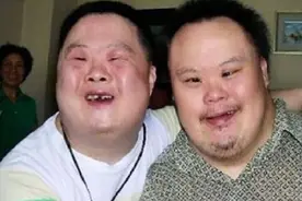 为什么唐氏综合征患者长的几乎都一模一样？今天总算明白了视频封面