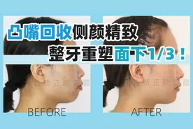 深圳牙齿矫正：凸嘴回收至审美线上，收获精致侧颜！