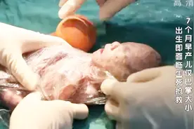 袖珍婴儿4：孩子终于出生了！但胳膊，却只有成年人的手指粗细！视频封面