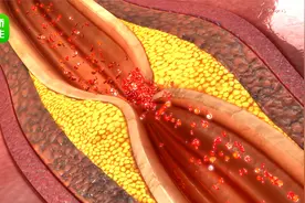 原发性高血压VS继发性高血压，别再傻傻分不清！视频封面