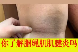 腘窝疼痛怎么回事？有一种膝关节病叫腘绳肌肌腱炎视频封面