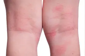 常海沧：膝盖很痒，还长小红点？注意了，有可能是湿疹！视频封面