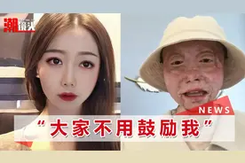 四川烧伤女孩经历12次手术重生，开直播透露近况：请把我当正常人