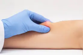 胳膊上长脂肪瘤常见有3种原因 ，要注意视频封面