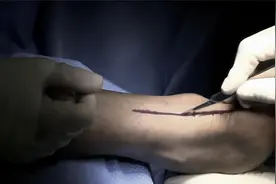 跟腱断裂——大创面手术缝合、迷你开放修复和经皮微创缝合！视频封面