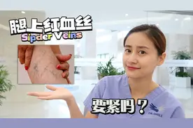 腿上惊现红血丝？这是静脉曲张吗？