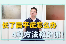 长了扁平疣怎么办？试试这4种方法，帮你消灭小疙瘩！视频封面
