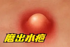 脚上磨起了泡怎么办？要不要挑破?视频封面