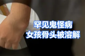 13岁女孩患罕见大块骨溶解症（鬼怪病），骨移植术后发生关节脱位视频封面
