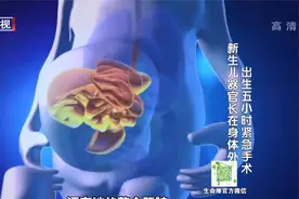 4斤婴儿肚子隆起大圆球，器官长在身体外，竟被一塑料袋救回