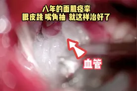 用特殊“棉花”隔开神经与血管，8年眼皮跳嘴角抽就治好了视频封面