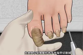 你知道灰指甲是如何形成的吗？不一样的解压视频，一起来看看吧！