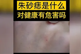 #白月光朱砂痣 爆火的#朱砂痣 究竟是什么听听皮肤科医生的解释，