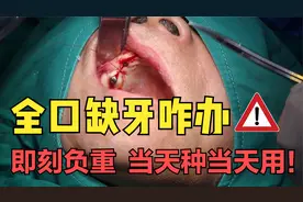 全口缺失牙怎么办？即刻负重种植修复来搞定！