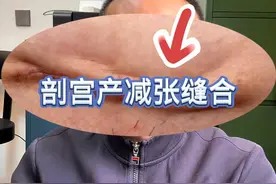 5分钟了解什么是剖宫产的美容缝合 #剖宫产疤痕  #剖宫产疤痕增生  #剖宫产手术 