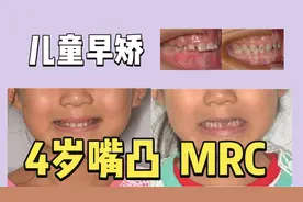 早矫日记 | 4岁小朋友嘴凸咬下唇，7个月MRC矫正
