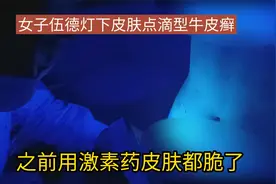 女子伍德灯下皮肤点滴型牛皮癣。之前用激素药皮肤都脆了