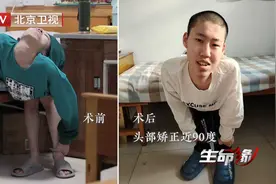 Z字折叠男孩姜延琛第一阶段治疗结束，头部矫正近90度（终）