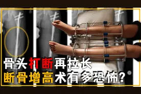 把骨头打断再人为拉长，断骨增高术有多恐怖？手术的人如今怎样？视频封面