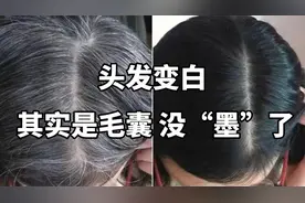 头发变白 其实是毛囊 没“墨”了