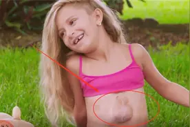 俄罗斯女孩心脏长在身体外部，能看到不停跳动，瞧着让人很心疼