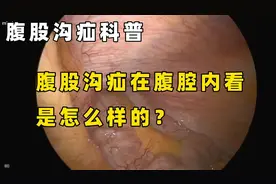 腹股沟疝的“洞”是怎样的？