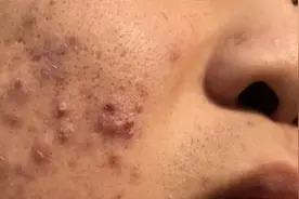 教你一招搞定顽固痘痘、红黑痘印！只需28天皮肤变干净！