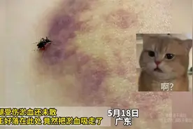 女子腿受伤淤血还未散，蚊子正好落在此处，竟然把淤血吸走了视频封面