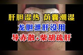 肝胆湿热 荫囊潮湿，龙胆泻肝没用！导赤散+柴胡疏肝视频封面