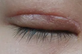 双眼皮留疤赶紧看！过来人分享保姆级教程！祛疤效果惊人！