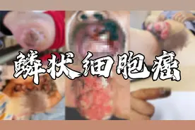 两个月夺走赵忠祥生命的恶性肿瘤是什么？视频封面