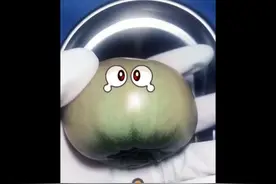 烧伤的清创与植皮