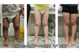 腿不直一定有问题吗？