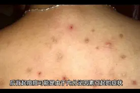 背部长痘痘的原因