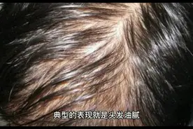 养血生发胶囊，适合干枯型的脱发视频封面