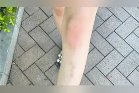 正经冷知识：女生腿上的淤青是怎么来的？