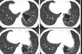 35岁女性，间断咯血入院，胸部CT发现囊性病灶，诊断什么？